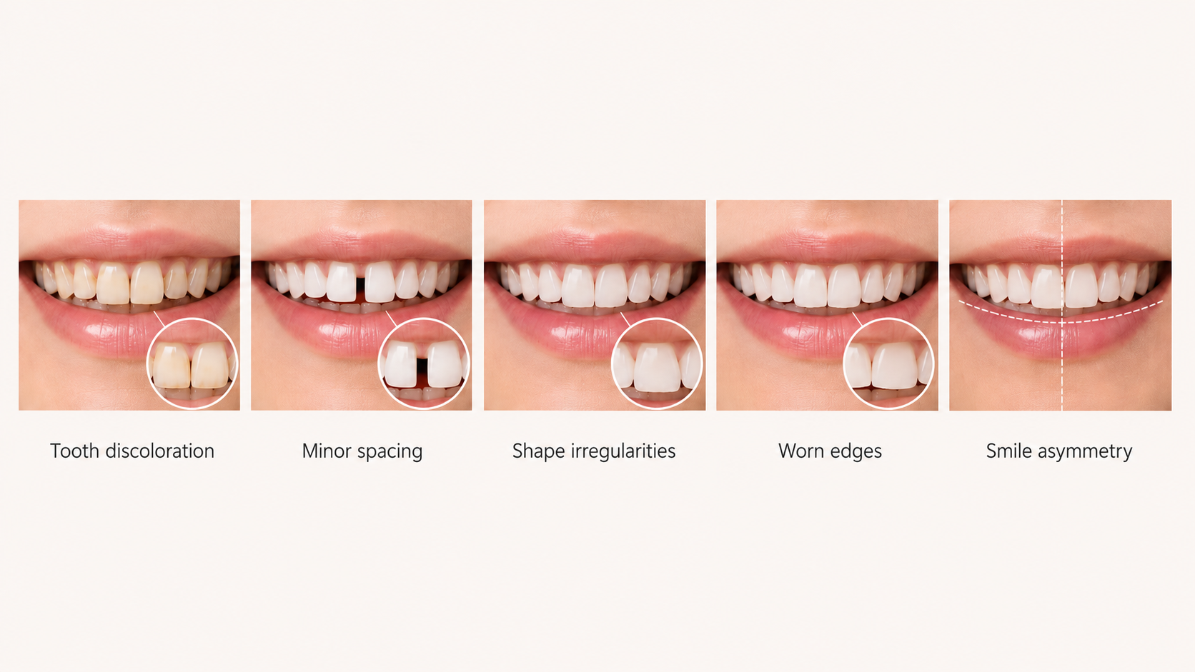 A comparison of five different dental issues with close-up images of teeth, including tooth discoloration, minor spacing, shape irregularities, worn edges, and smile asymmetry, each with a magnified inset highlighting the characteristic problem.