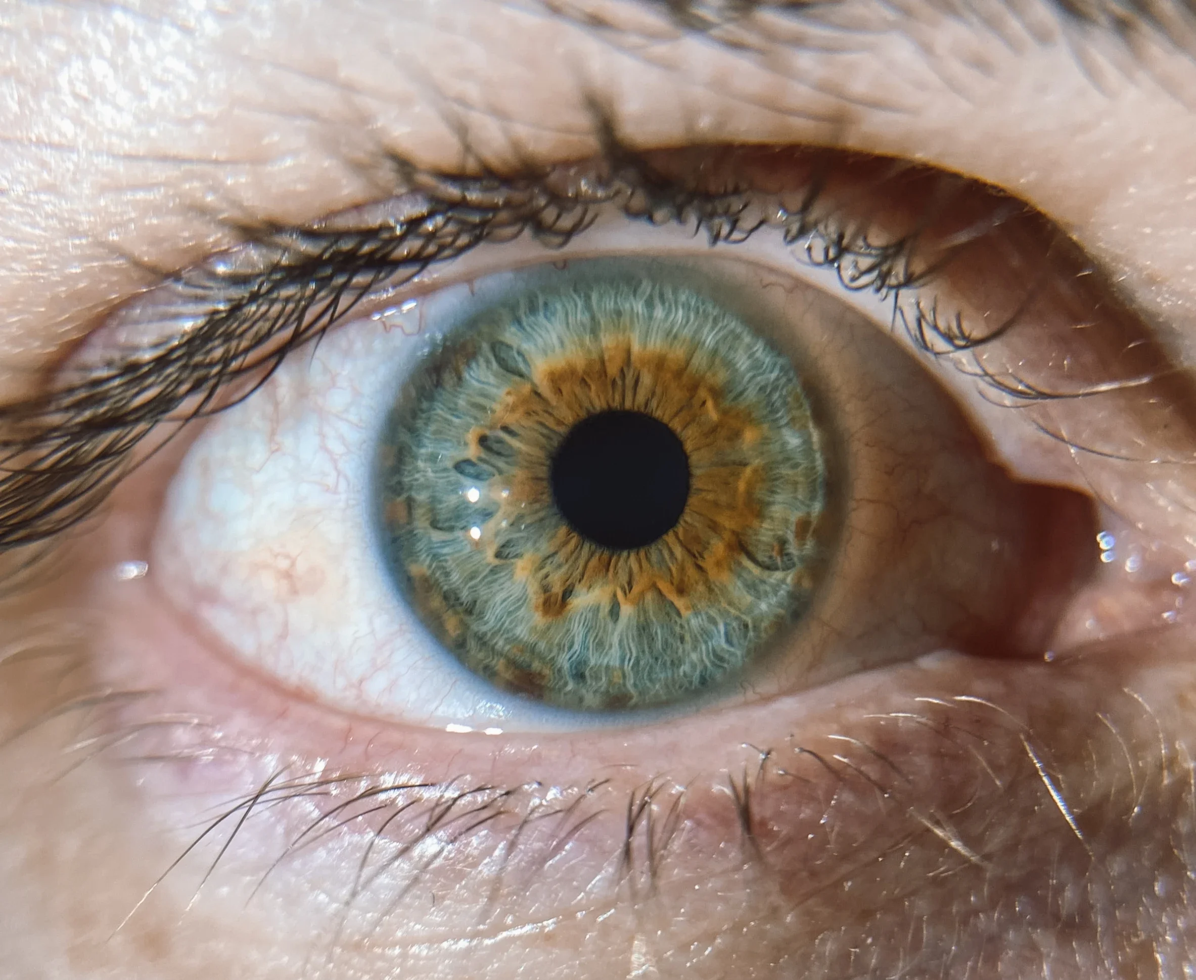 Iridology: it’s in the eyes
