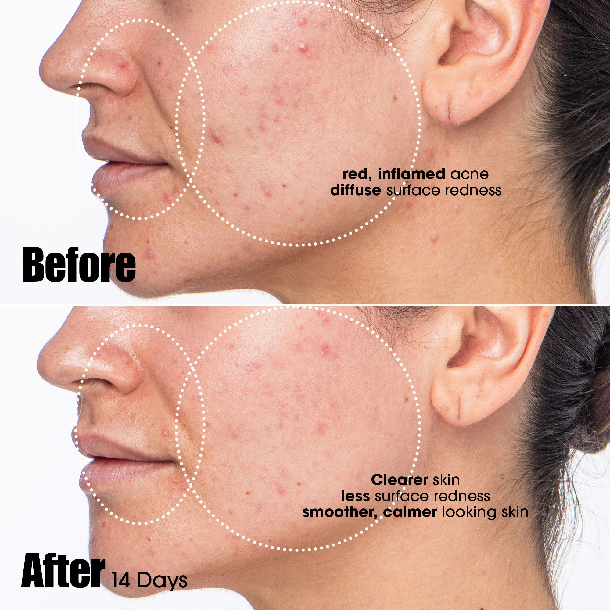 SR25 Sales NAM Acne Line Sephora PDP__Peacekeeper UPDATES_fromSephoraPeacekeeper_Frame 3.jpg