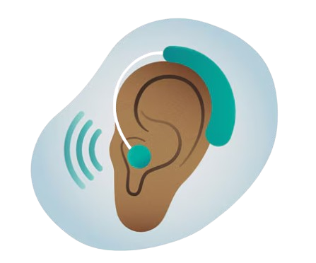 Illustration of a human ear with a hearing aid and sound waves indicating hearing enhancement.
