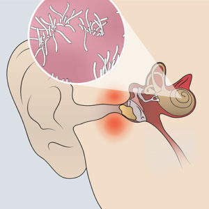 Diagram of a person experiencing sinus infection with inflammation and bacteria in the sinuses