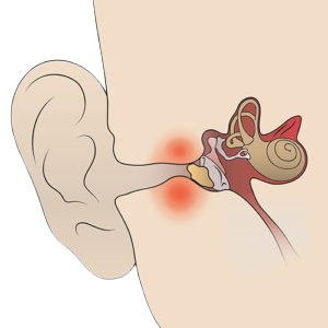 Diagram of human ear showing the ear canal, middle ear, and inner ear, with redness indicating inflammation or infection.