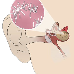 Diagram of the human nasal cavity showing the sinus infection with bacteria.