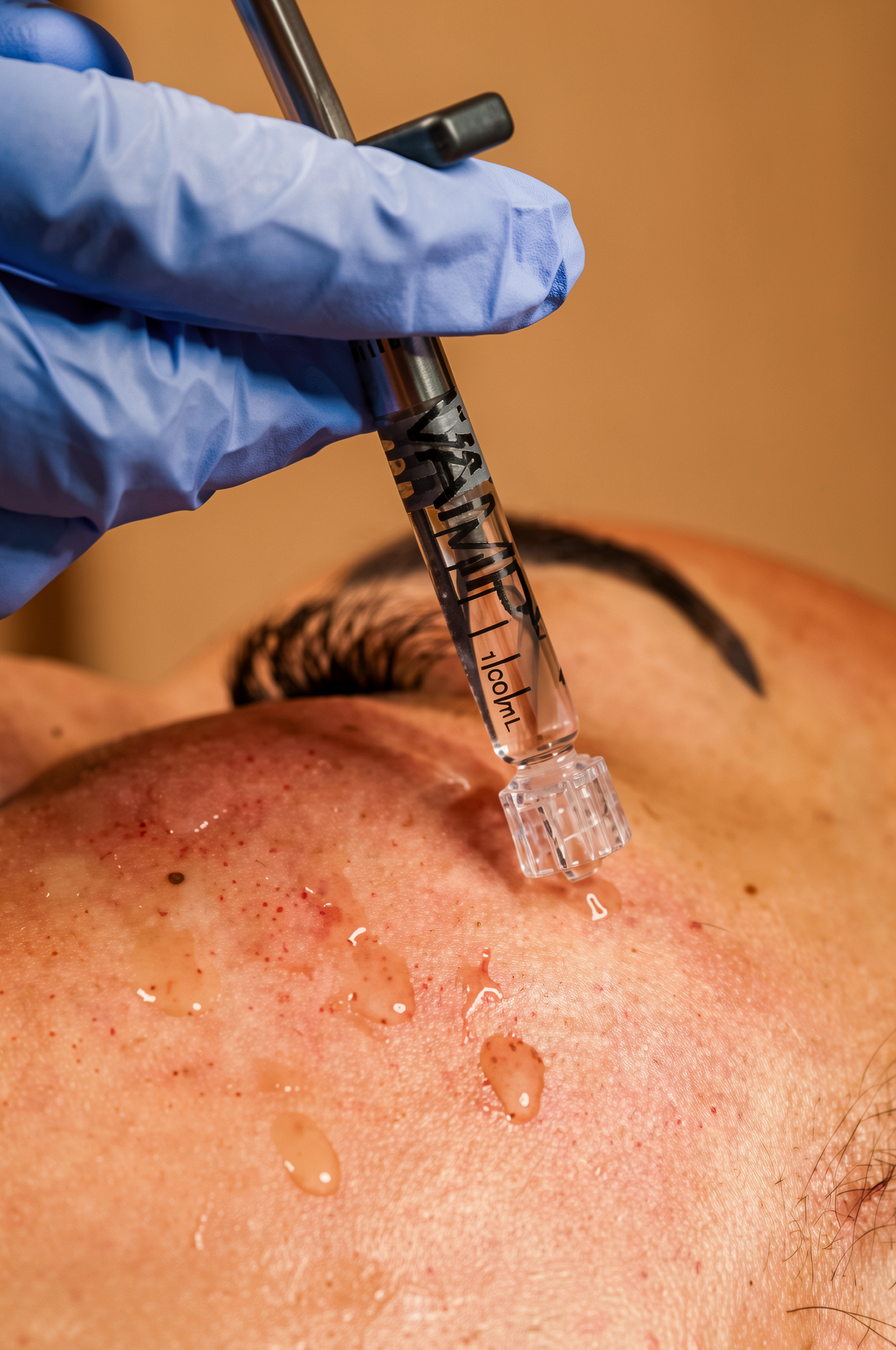 A microneedling procedure with a microneedling pen fluid into a person's skin, with liquid droplets on the skin and gloved hand holding the syringe.
