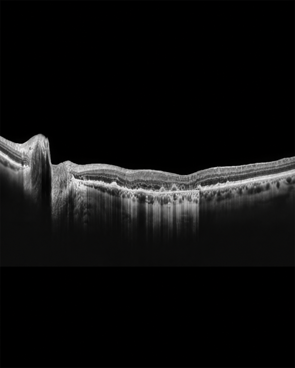 Blurry patch in centre of vision - Onej Optometry