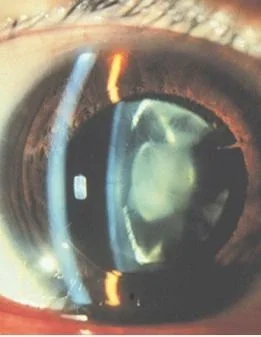 Glarey vision - Onej Optometry
