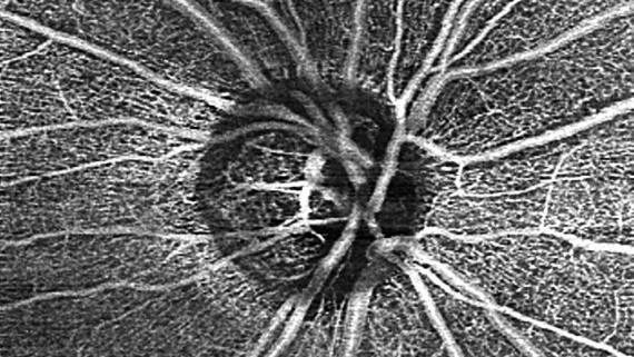 glaucoma peripheral vision - Onej Optometry