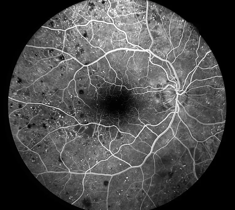 Black and white image of a human eye retina showing blood vessels and the optic nerve head.