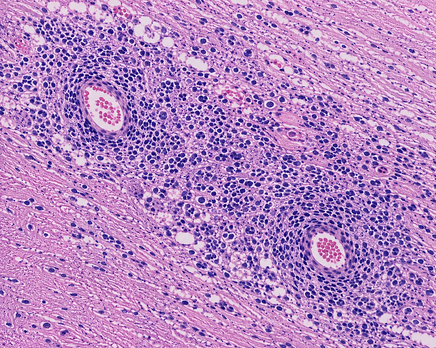 Microscopic cell changes during optic nerve swelling