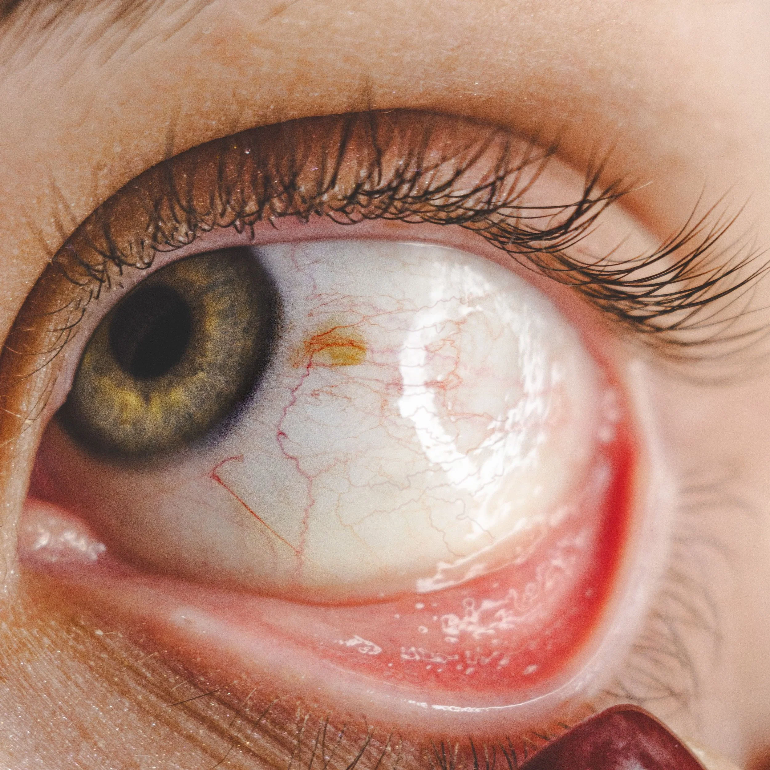 Close-up of a human eye with brown iris, multiple eyelashes, and visible blood vessels in the sclera.