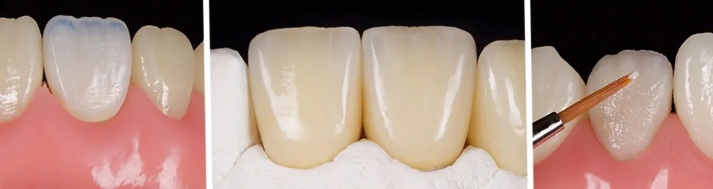 One day lecture - Ultimate Anterior Aesthetics