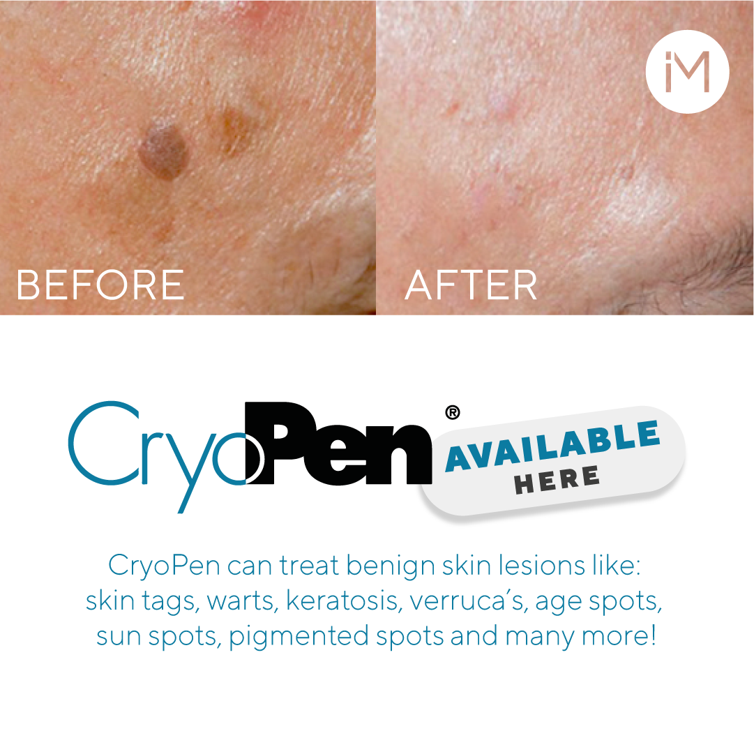 A before and after comparison of a person's skin showing the reduction of a mole or skin lesion after treatment. The advertisement for CryoPen, a treatment for benign skin lesions like skin tags, warts, and age spots, displayed below the images.