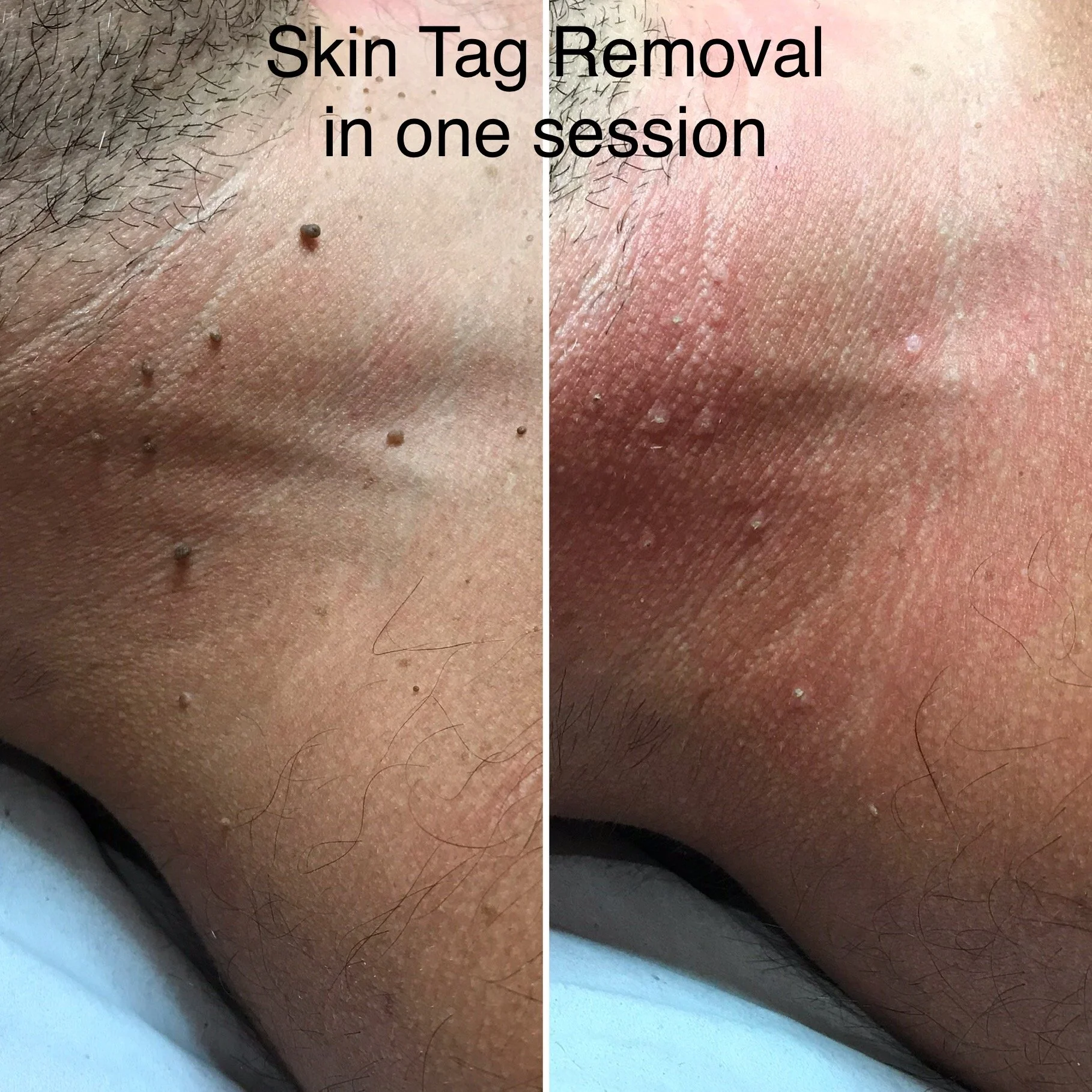 Comparison of skin before and after skin tag removal. The left side shows skin with multiple skin tags, while the right side shows clear skin after removal.