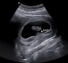 ultrasound 1.jpg