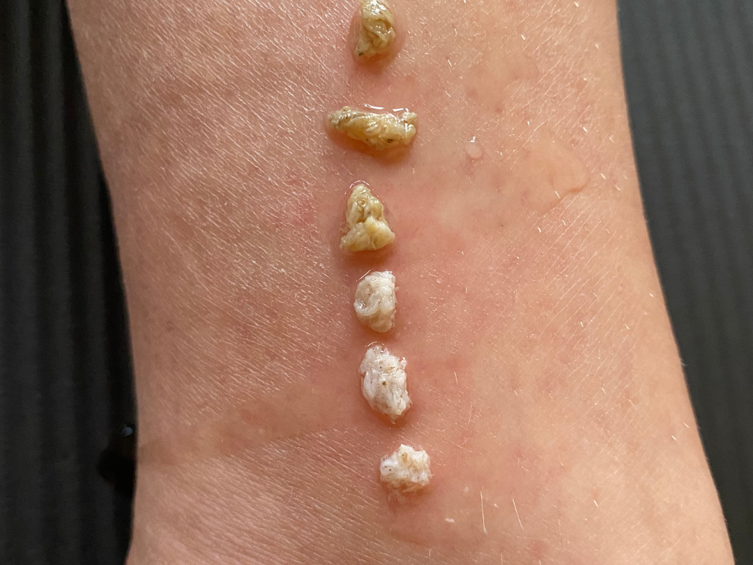 Close-up of a person's skin with Kambo dots placed on the Kambo gates.