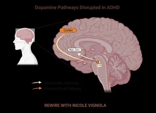 Diagram of disrupted dopamine pathways in the brain related to ADHD, highlighting the cortex, nucleus accumbens, and VTA.