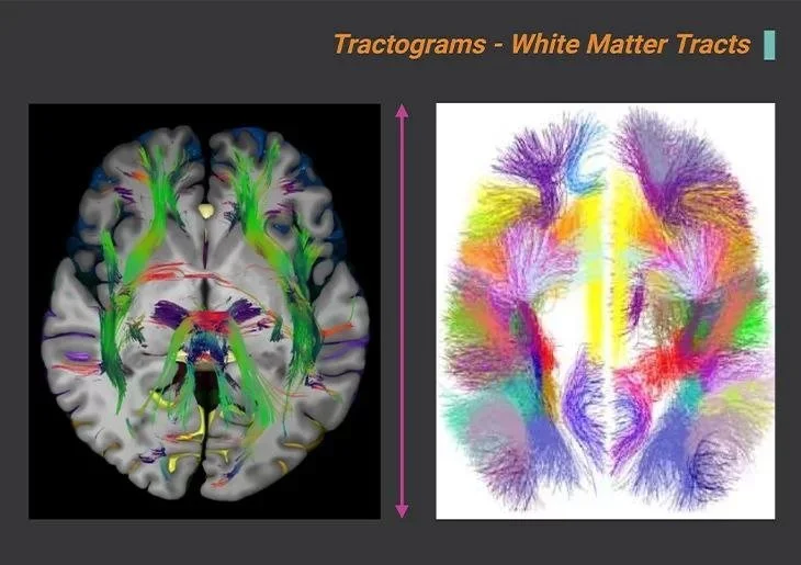 Brain tractograms showing white matter tracts with colorful fiber pathways, titled 'Tractograms - White Matter Tracts'.