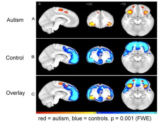 Brain scans comparing autism and control groups, with overlays highlighting differences in activity, using red for autism and blue for controls.