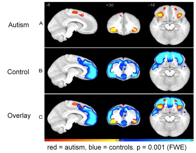 Brain scans comparing autism and control groups, showing significant differences in brain activity with red indicating autism and blue indicating controls.