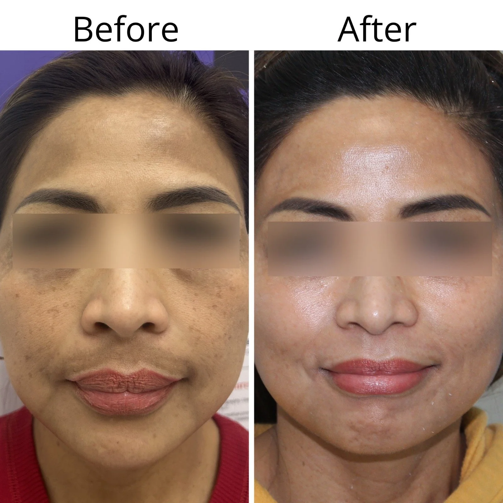 Side-by-side comparison of a woman's face before and after skincare treatment, showing improved skin clarity and texture.