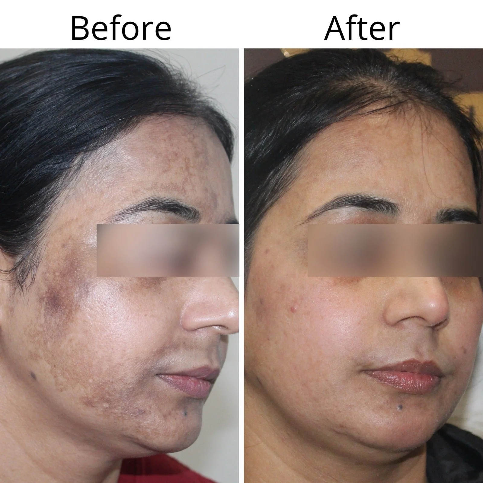 Side-by-side comparison of a woman's face showing improvements in skin condition, labeled 'Before' and 'After'.