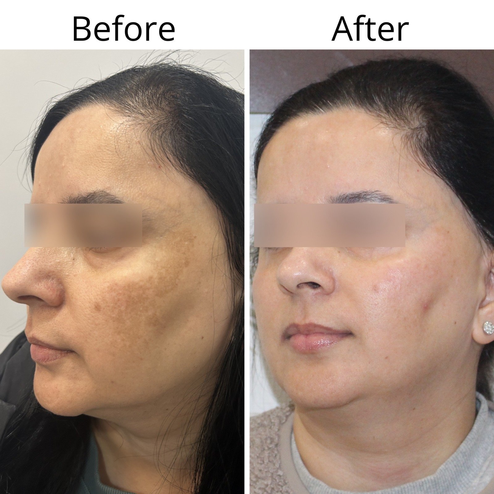 Comparison of a woman's face before and after skin treatment showing improved skin clarity and texture.