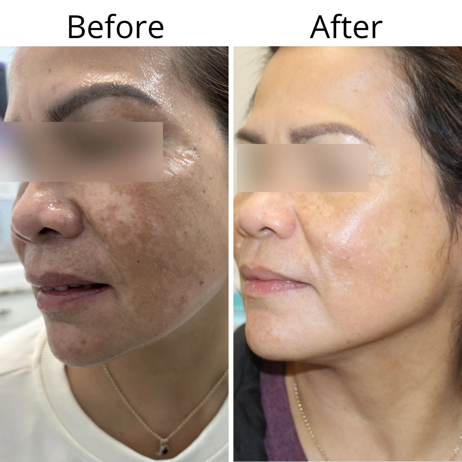 Side-by-side comparison of a woman before and after skin treatment, showing improved skin texture and reduction of hyperpigmentation.