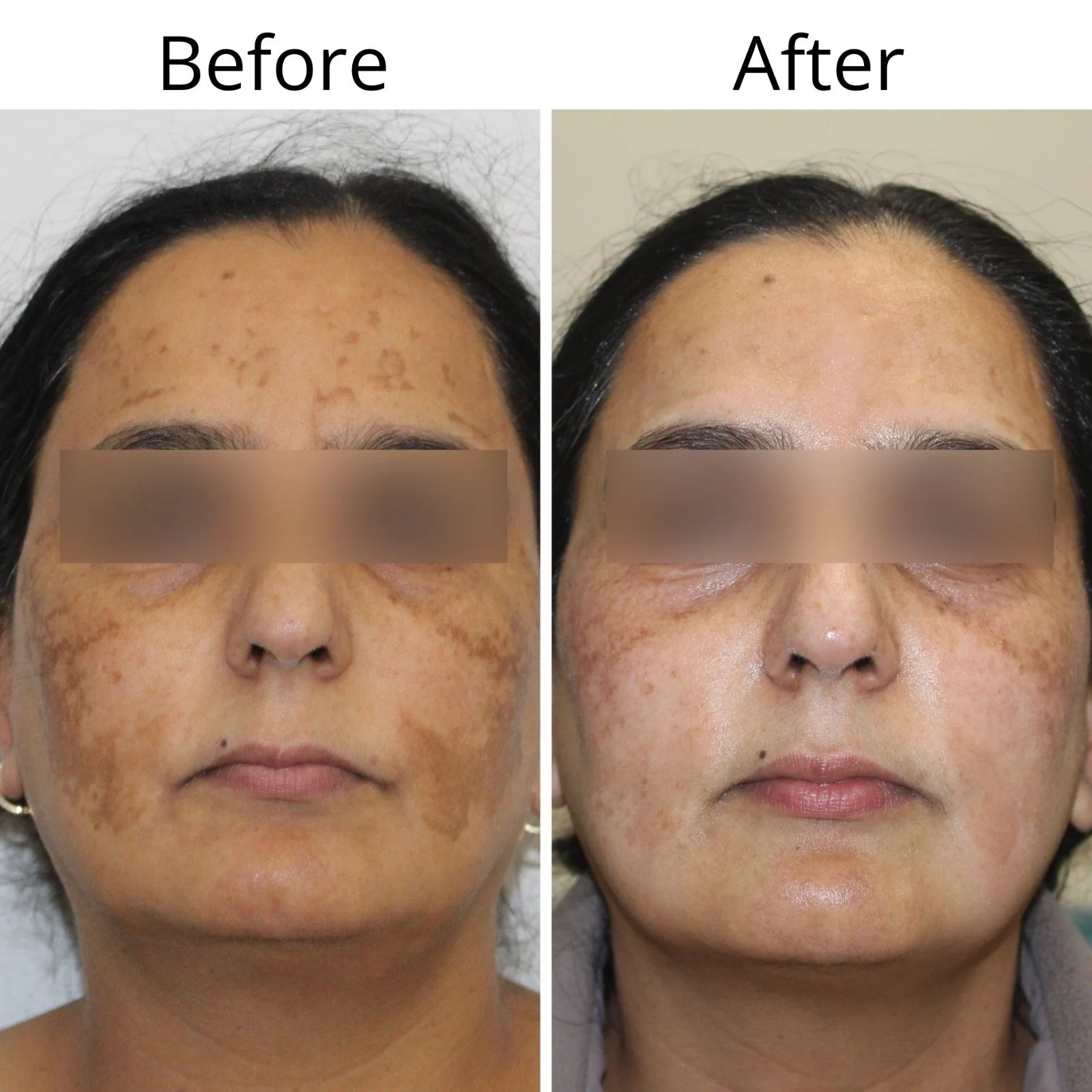 Side-by-side comparison of a woman's face showing skin improvement before and after a treatment for hyperpigmentation and dark spots, with the 'Before' on the left and 'After' on the right.