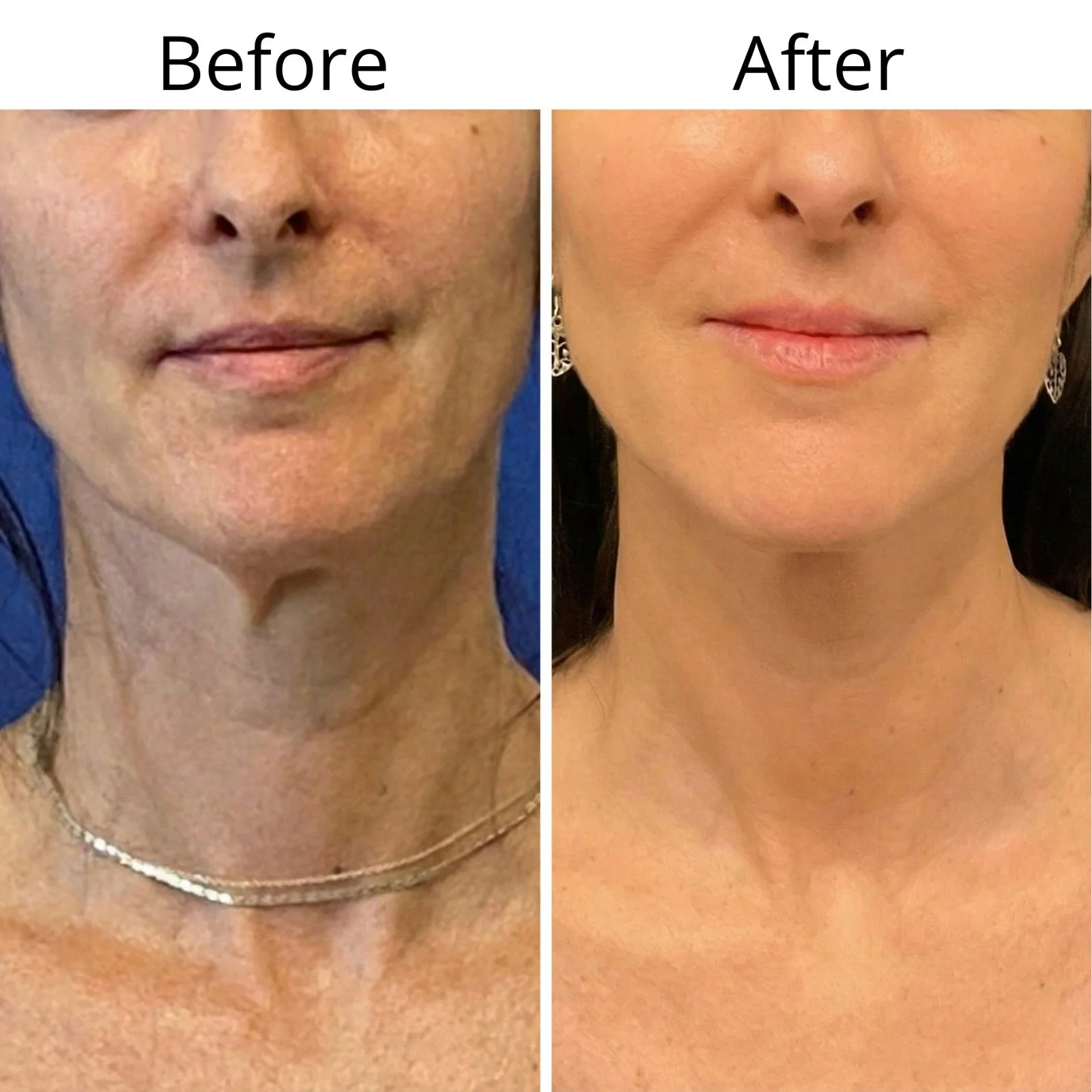 Side-by-side comparison of a woman's face before and after a skin treatment, showing improved skin texture and appearance.