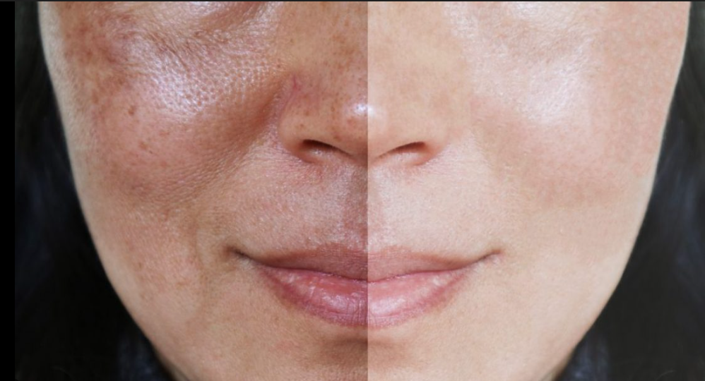 Close-up of a woman's face showing a before-and-after comparison of skin texture and appearance.