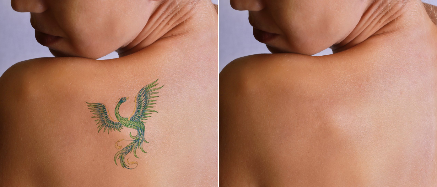 Close-up of a woman's shoulder with a phoenix tattoo on her upper back, and the same shoulder without the tattoo, both viewed from the side.