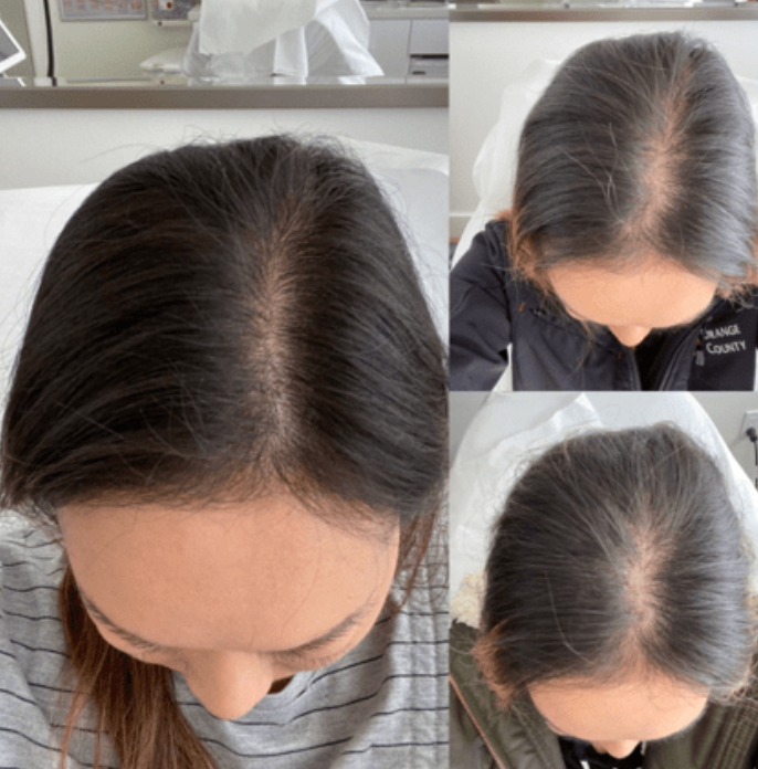 A collage of three photos showing the top view of a woman with dark hair, highlighting her scalp and hair thinning area. She is in a medical setting.