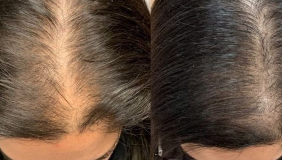 Comparison of a person's scalp showing significant hair thinning on the left side and fuller hair on the right side.