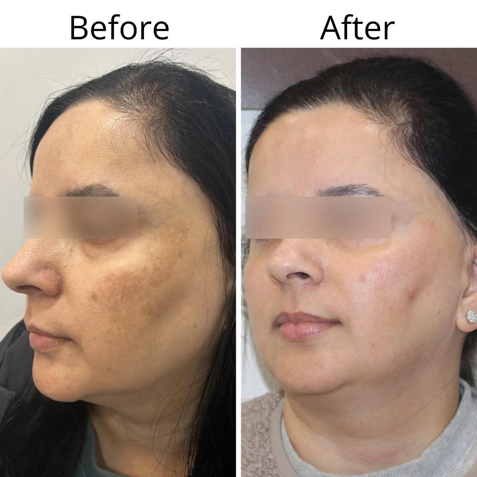 Side-by-side comparison of a woman's face showing hair loss on the left and improved hair growth on the right, labeled 'Before' and 'After'.