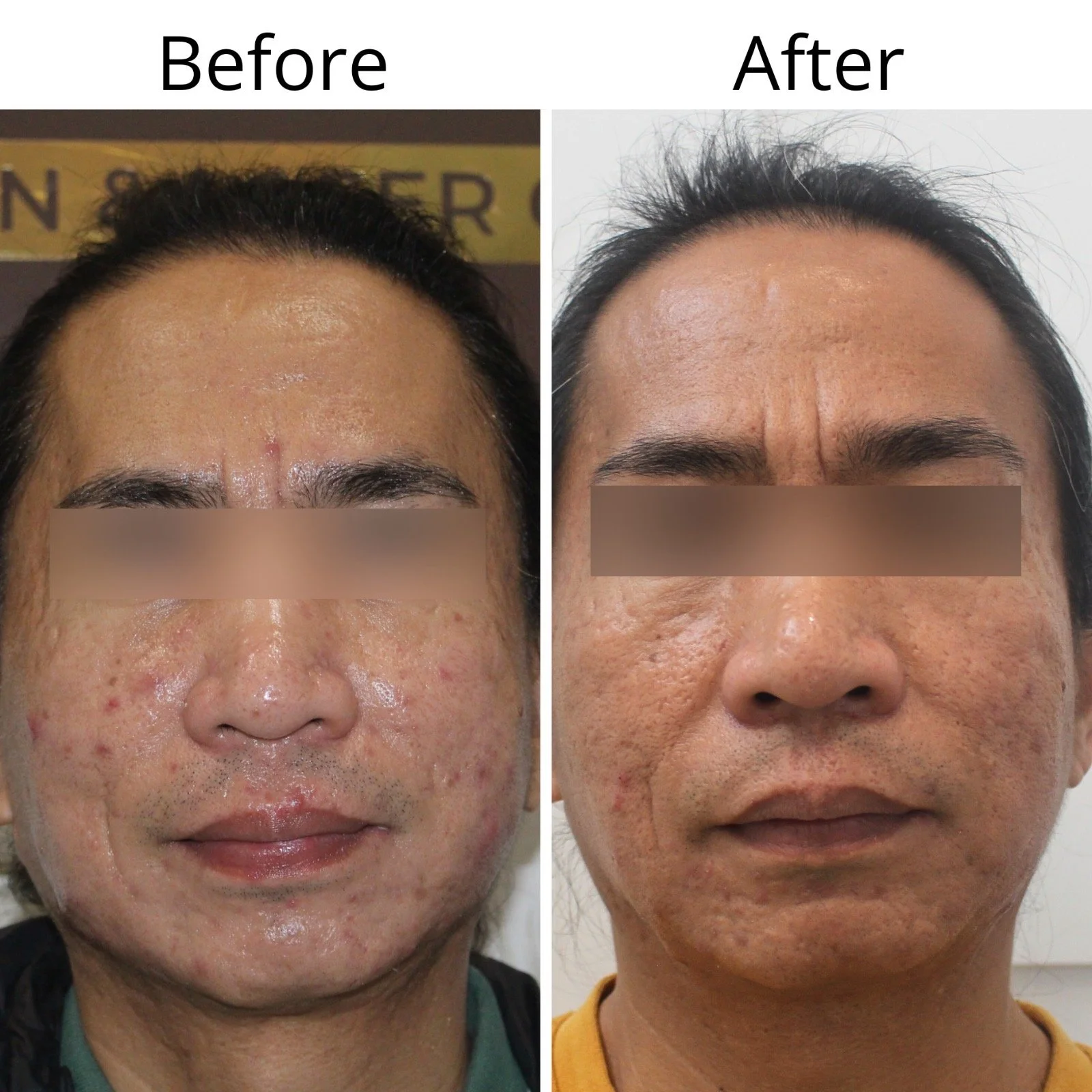 Side-by-side comparison of a person's face before and after skin treatment, showing improvement in skin texture and reduction of acne and redness.
