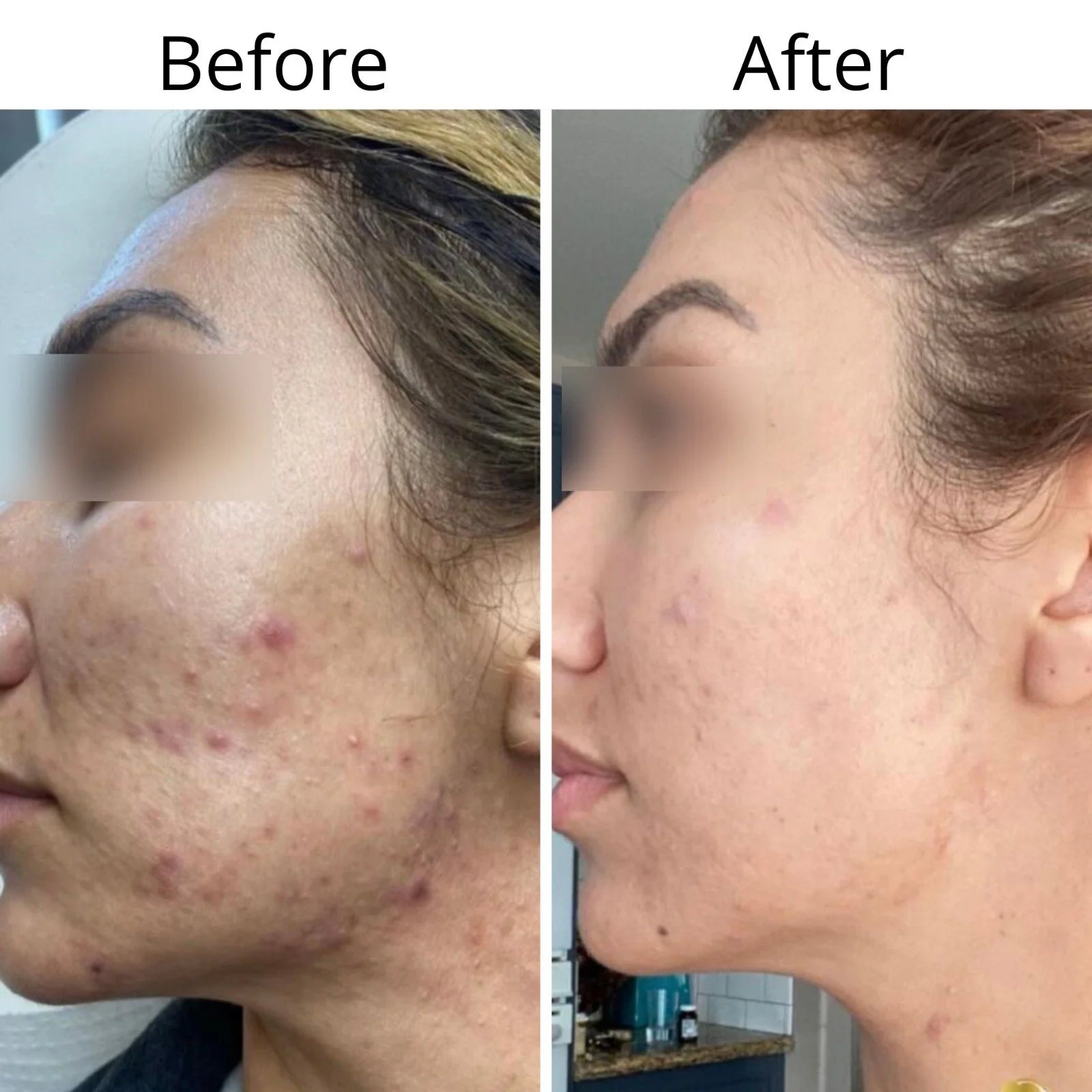 Comparison of a woman's face before and after skincare treatment showing reduced acne and clearer skin.