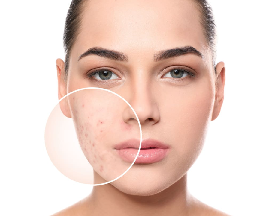 Close-up of a woman's face with acne on her left cheek highlighted by a magnified circle.