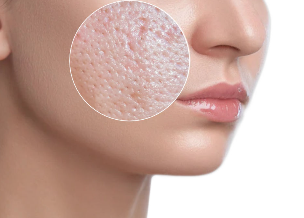Close-up of a woman's cheek with a magnified view of skin showing large pores and uneven texture.