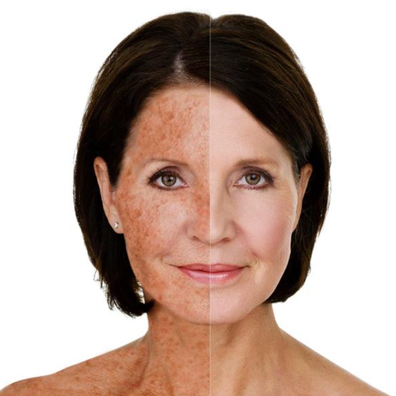 Split image of a woman showing aging and skin damage on the left side, and clear, youthful skin on the right side.
