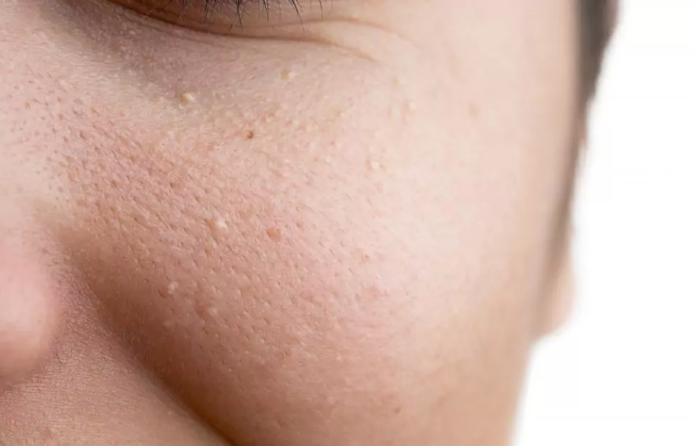 Close-up of a person's cheek showing visible large pores and skin bumps.