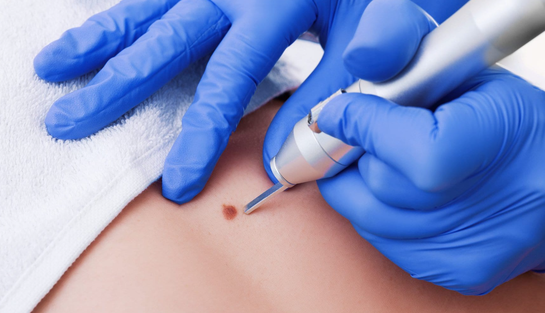 A person in blue medical gloves performing a skin biopsy or mole removal with a medical tool on a person's skin.