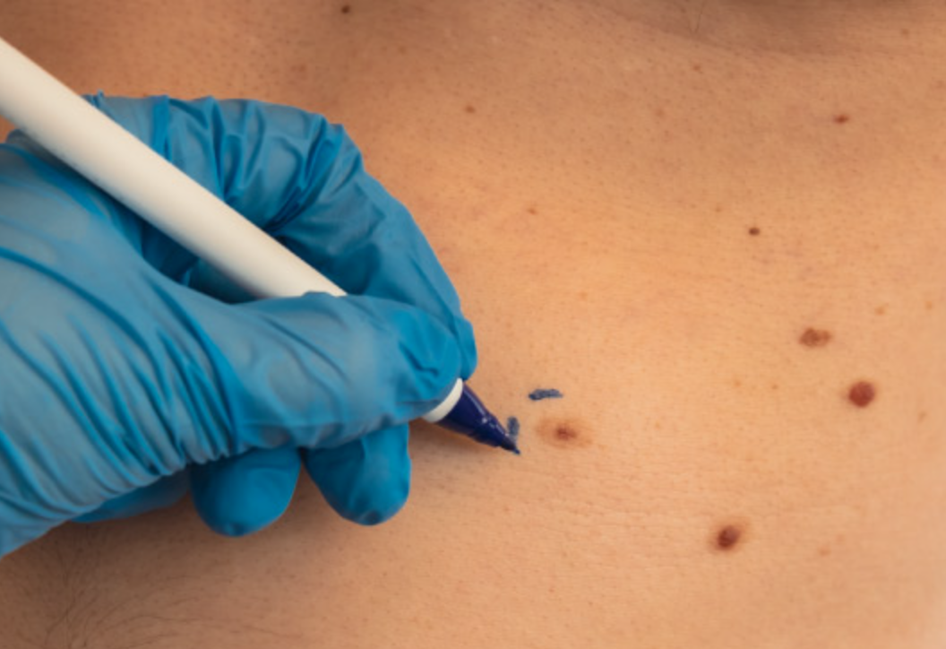 Close-up of a person wearing a blue medical glove drawing black dots on skin with a marker.