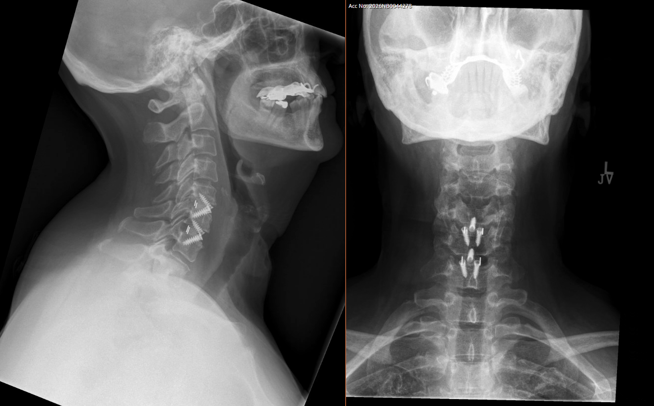 X-ray images showing the side and front views of a person's neck and upper spine with visible surgical hardware, including screws and rods.