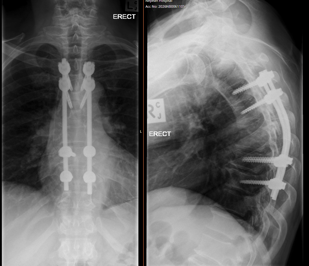 X-ray of a person's chest showing spinal hardware, including rods and screws, indicating spinal surgery.