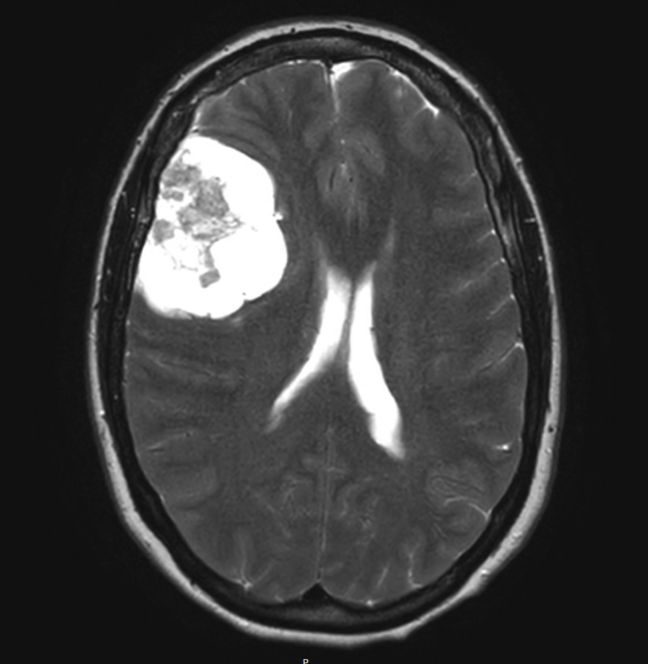 MRI scan of a human brain showing a tumor in the upper left region.