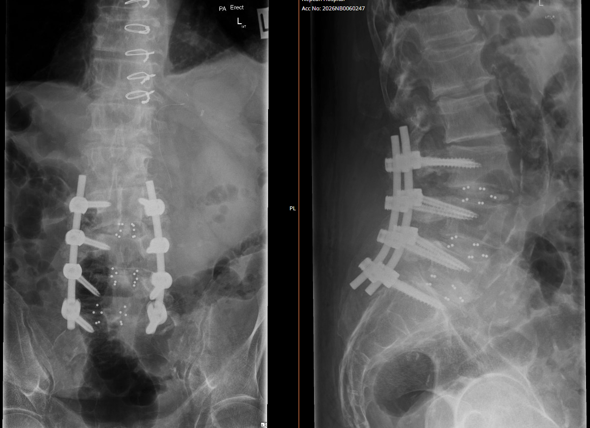 X-ray images of the pelvis and lower spine showing spinal fusion with metal screws and rods.