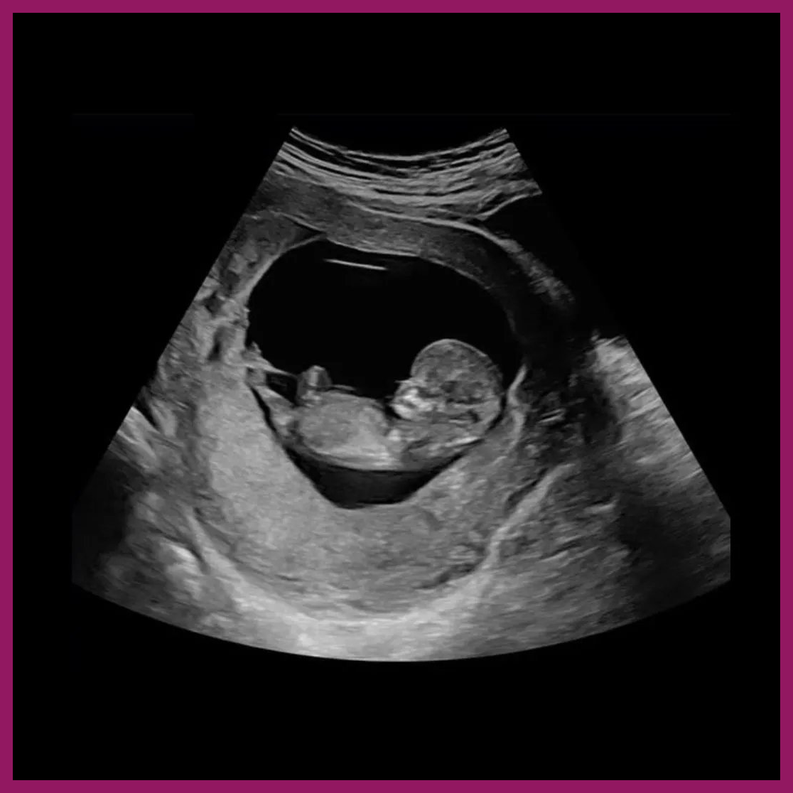 Early Pregnancy Baby Scan Cardiff