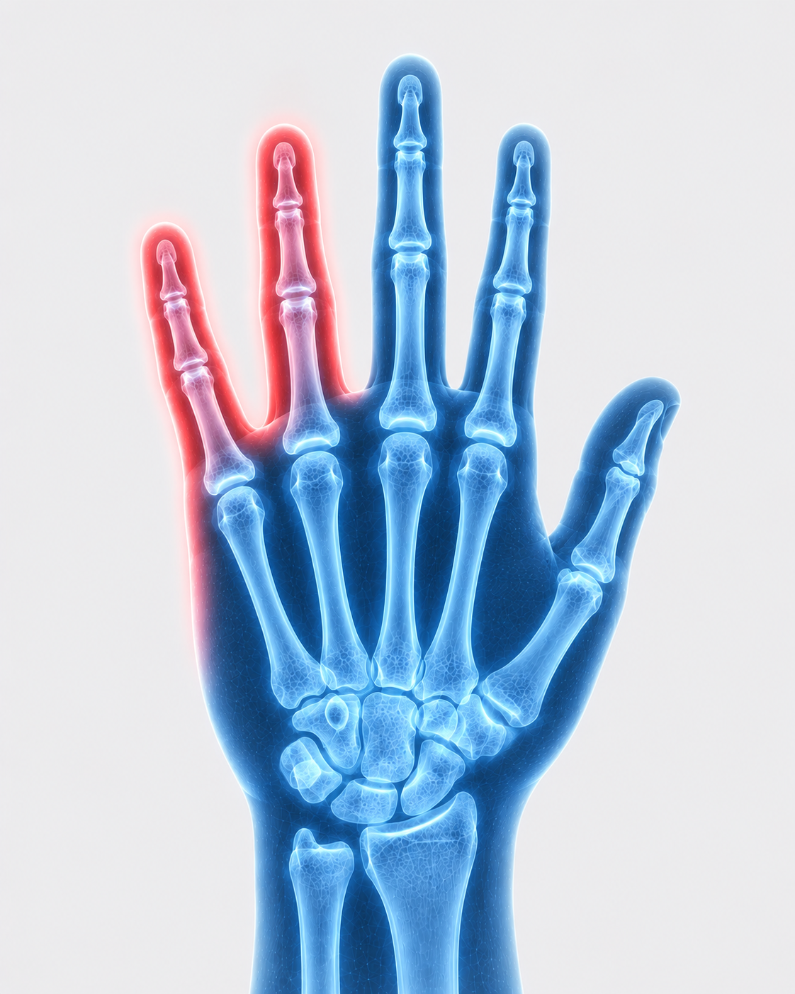 X-ray of a human hand with the ring finger highlighted in red, indicating pain or injury.