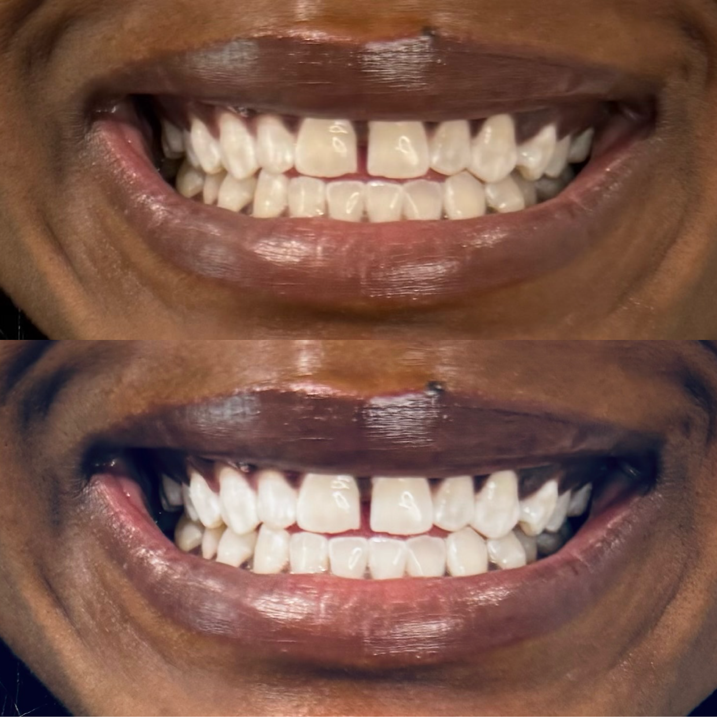 Close-up of a person's mouth showing before and after teeth whitening results, showing improved whiteness and brightness of the teeth in the after image.