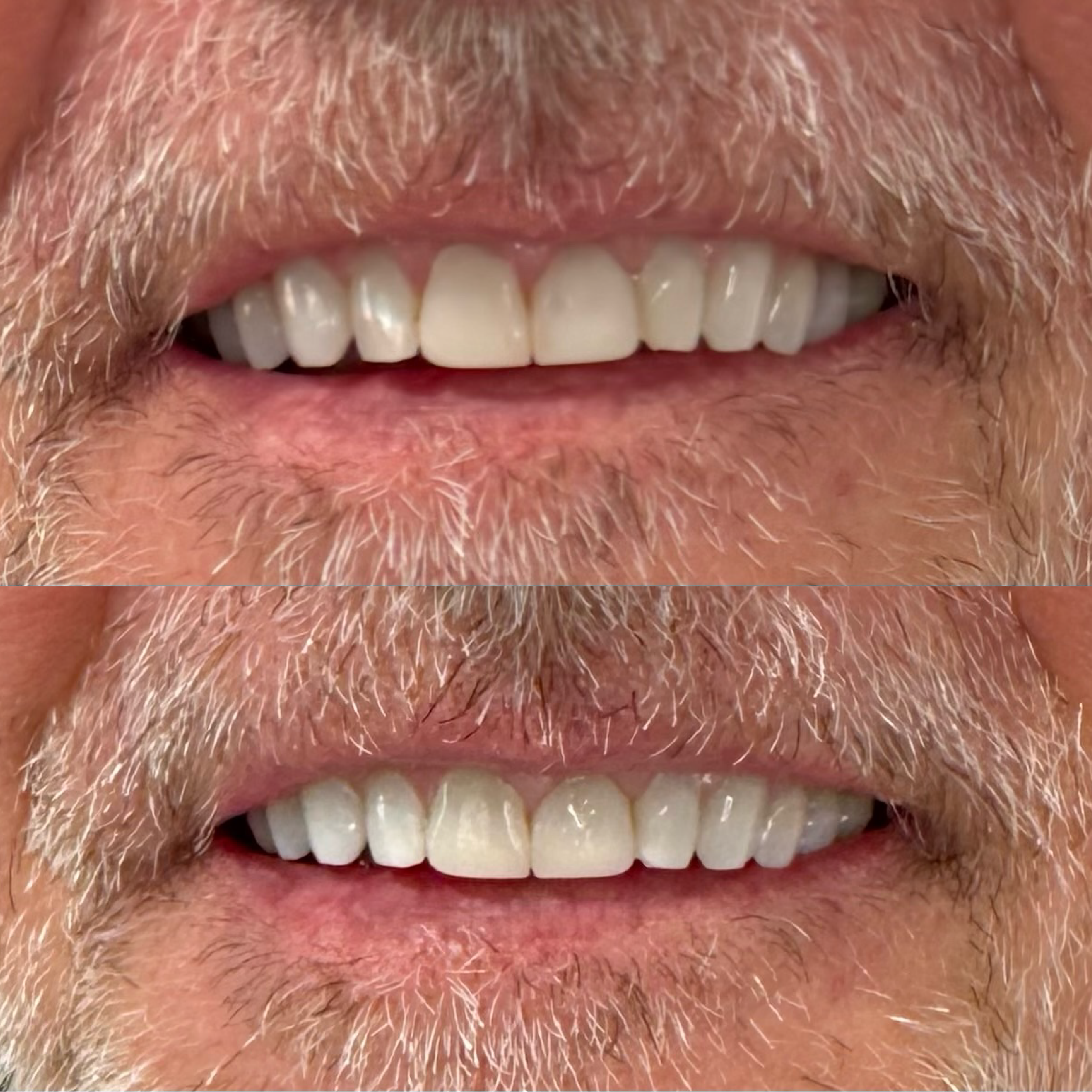 Close-up of a person's mouth showing before and after teeth whitening results, showing improved whiteness and brightness of the teeth in the after image.